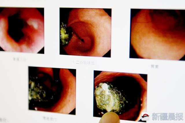 9岁女孩胃里取出4厘米头发团